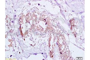 Formalin-fixed and human breast carcinoma tissue labeled with Anti-GTPBP10 Polyclonal Antibody (ABIN750748), Unconjugated at 1:200 followed by conjugation to the secondary antibody and DAB staining (GTPBP10 Antikörper  (AA 151-250))