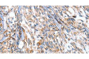 Immunohistochemistry of paraffin-embedded Human esophagus cancer using APOBEC3D Polyclonal Antibody at dilution of 1:80 (APOBEC3D Antikörper)