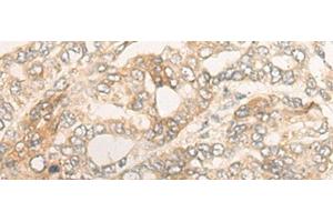 Immunohistochemistry of paraffin-embedded Human liver cancer tissue using DUOX2 Polyclonal Antibody at dilution of 1:40(x200) (DUOX2 Antikörper)