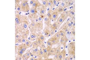 Immunohistochemistry of paraffin-embedded human liver cancer using TXNRD2 antibody at dilution of 1:100 (x40 lens). (TXNRD2 Antikörper)