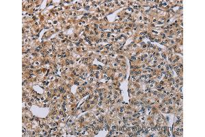 Immunohistochemistry of Human lung cancer using PNPT1 Polyclonal Antibody at dilution of 1:40 (PNPT1 Antikörper)