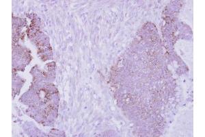 IHC-P Image Immunohistochemical analysis of paraffin-embedded human colon carcinoma, using Arginase II, antibody at 1:250 dilution. (ARG2 Antikörper  (Center))