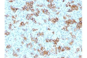 Formalin-fixed, paraffin-embedded human Hodgkin's Lymphoma stained with CD30 Monoclonal Antibody (Ki-1/779). (TNFRSF8 Antikörper)