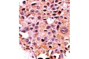 Formalin-fixed and paraffin-embedded human cancer tissue reacted with the primary antibody, which was peroxidase-conjugated to the secondary antibody, followed by AEC staining. (PPP3CA Antikörper  (N-Term))
