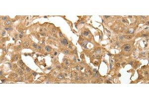 Immunohistochemistry of paraffin-embedded Human lung cancer using TXN Polyclonal Antibody at dilution of 1:40 (TXN Antikörper)