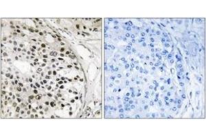 Immunohistochemistry analysis of paraffin-embedded human breast carcinoma tissue, using MNK1 (Ab-250) Antibody. (MKNK1 Antikörper  (AA 216-265))