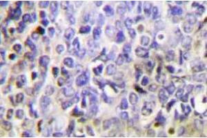 Immunohistochemistry analysis of Granzyme K in paraffin-embedded human lung carcinoma tissue. (GZMK Antikörper)