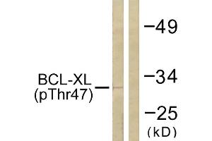 Immunohistochemistry analysis of paraffin-embedded human lung carcinoma tissue using BCL-XL (Phospho-Thr47) antibody.