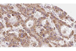 ABIN6279547 at 1/100 staining Human liver cancer tissue by IHC-P.