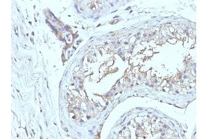 Formalin-fixed, paraffin-embedded human Testicular Ca stained with CD63 Monoclonal Antibody (NKI/C3 + LAMP3/968) (CD63 Antikörper)