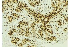 ABIN6277629 at 1/100 staining Human breast cancer tissue by IHC-P. (PRDM14 Antikörper  (N-Term))