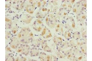 Immunohistochemistry of paraffin-embedded human gastric cancer using ABIN7158732 at dilution of 1:100 (LYSMD1 Antikörper  (AA 1-227))