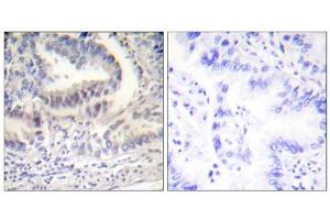 Immunohistochemical analysis of paraffin-embedded human lung carcinoma tissue using Lamin A (Cleaved-Asp230) Antibody (ABIN5978456). (Lamin A/C Antikörper  (Cleaved-Asp230, Internal Region))