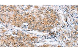 Immunohistochemistry of paraffin-embedded Human gastric cancer using CRELD2 Polyclonal Antibody at dilution of 1:50 (CRELD2 Antikörper)
