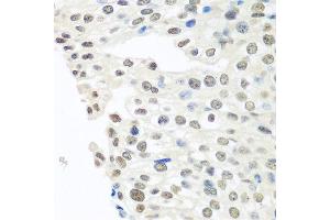 Immunohistochemistry of paraffin-embedded human prostate cancer using TARDBP antibody at dilution of 1:100 (40x lens). (TARDBP Antikörper)