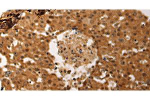 Immunohistochemistry of paraffin-embedded Human ovarian cancer tissue using JUND Polyclonal Antibody at dilution 1:60