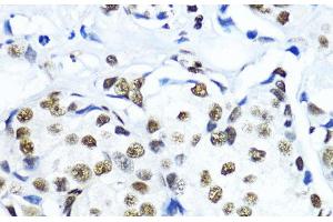 Immunohistochemistry of paraffin-embedded Human mammary cancer using TriMethyl-Histone H3-K79 Polyclonal Antibody at dilution of 1:200 (40x lens). (Histone 3 Antikörper  (3meLys79))