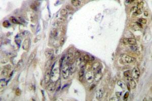 Immunohistochemical analysis of paraffin-embedded human colon cancer tissue using TCF7 polyclonal antibody .
