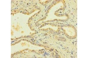 Immunohistochemistry of paraffin-embedded human prostate cancer using ABIN7166618 at dilution of 1:100 (PRY Antikörper  (AA 13-147))
