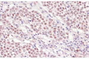 Immunohistochemistry of paraffin-embedded Human cervix cancer using SNRNP70 Polyclonal Antibody at dilution of 1:100 (40x lens).