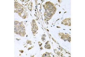 Immunohistochemistry of paraffin-embedded human gastric cancer using SBDS antibody (ABIN5973483) at dilution of 1/100 (40x lens). (SBDS Antikörper)