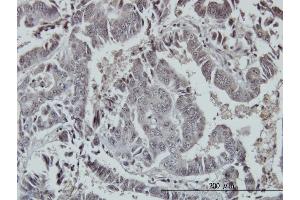 Immunoperoxidase of monoclonal antibody to FOXO3A on formalin-fixed paraffin-embedded human colon adenocarcinoma. (FOXO3 Antikörper  (AA 361-460))