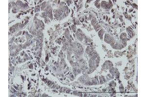 Immunoperoxidase of monoclonal antibody to FOXO3A on formalin-fixed paraffin-embedded human colon adenocarcinoma. (FOXO3 Antikörper  (AA 361-460))