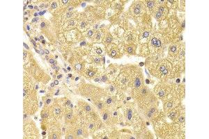 Immunohistochemistry of paraffin-embedded Human liver damage using TRAF3IP2 Polyclonal Antibody at dilution of 1:100 (40x lens). (TRAF3IP2 Antikörper)