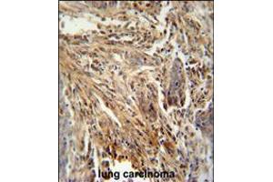 CSF2 antibody immunohistochemistry analysis in formalin fixed and paraffin embedded human lung carcinoma followed by peroxidase conjugation of the secondary antibody and DAB staining. (GM-CSF Antikörper  (AA 59-85))