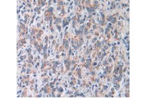 IHC-P analysis of Human Prostate Gland Cancer Tissue, with DAB staining. (SOD2 Antikörper  (AA 25-222))