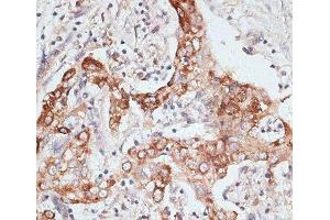 Immunohistochemistry of paraffin-embedded Human liver cancer using PIGR Polyclonal Antibody at dilution of 1:100 (40x lens). (PIGR Antikörper)