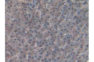 IHC-P analysis of Human Liver Cancer Tissue, with DAB staining. (CD55 Antikörper  (AA 35-285))