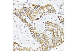 Immunohistochemistry of paraffin-embedded human colon carcinoma using MAVS antibody (ABIN6132297, ABIN6143583, ABIN6143584 and ABIN6221441) at dilution of 1:100 (40x lens). (MAVS Antikörper  (AA 1-65))
