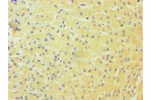 Immunohistochemistry of paraffin-embedded human liver cancer using ABIN7144985 at dilution of 1:100 (DDX3X Antikörper  (AA 1-220))