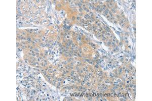 Immunohistochemistry of Human cervical cancer using SLIT2 Polyclonal Antibody at dilution of 1:30