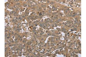 The image on the left is immunohistochemistry of paraffin-embedded Human ovarian cancer tissue using ABIN7192692(STMN2/STMN3/STMN4 Antibody) at dilution 1/45, on the right is treated with synthetic peptide. (STMN2/STMN3/STMN4 Antikörper)