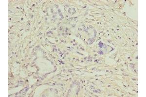 Immunohistochemistry of paraffin-embedded human pancreatic cancer using ABIN7158038 at dilution of 1:100 (LRG1 Antikörper  (AA 36-346))
