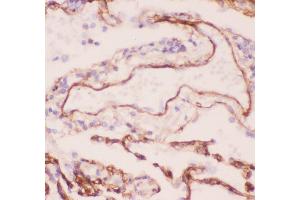 Anti-Collagen IV Picoband antibody,  IHC(P): Human Lung Cancer Tissue (COL4A1 Antikörper  (AA 1445-1669))
