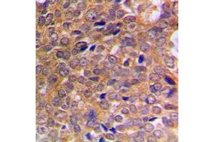 Immunohistochemical analysis of ABL1/2 (pY393/439) staining in human breast cancer formalin fixed paraffin embedded tissue section. (ABL1/2 Antikörper  (C-Term, pTyr393, pTyr439))