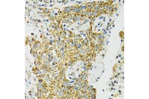 Immunohistochemistry of paraffin-embedded human lung cancer using HSPA9 antibody. (HSPA9 Antikörper  (AA 380-679))
