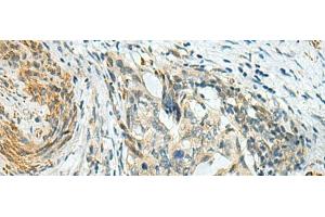 Immunohistochemistry of paraffin-embedded Human cervical cancer tissue using PLPPR5 Polyclonal Antibody at dilution of 1:120(x200) (LPPR5 Antikörper)