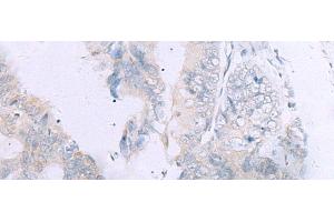 Immunohistochemistry of paraffin-embedded Human colorectal cancer tissue using GPC3 Polyclonal Antibody at dilution of 1:60(x200) (Glypican 3 Antikörper)