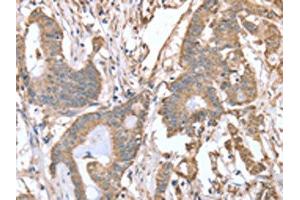 The image on the left is immunohistochemistry of paraffin-embedded Human colon cancer tissue using ABIN7128119(ABCB6 Antibody) at dilution 1/15, on the right is treated with fusion protein. (ABCB6 Antikörper)