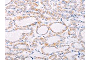 The image on the left is immunohistochemistry of paraffin-embedded Human thyroid cancer tissue using ABIN7189808(ANKRD26 Antibody) at dilution 1/25, on the right is treated with synthetic peptide. (ANKRD26 Antikörper)