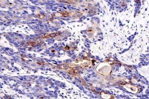 Immunohistochemistry analysis of paraffin-embedded human esophageal cancer using MIIP (ABIN7074626) at dilution of 1: 1200 (MIIP Antikörper)