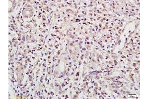 Formalin-fixed and paraffin embedded human gastric carcinoma labeled with Anti RBPJK/RBP-J Polyclonal Antibody, Unconjugated (ABIN872972) at 1:200 followed by conjugation to the secondary antibody and DAB staining