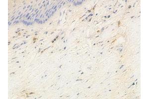 ABIN6263940 and ABIN6266908 at 1/100 staining human cervical carcinoma by IHC-P.