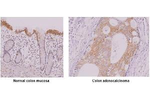 Paraffin embedded sections of normal colon mucosa and colon adenocalcinoma tissue were incubated with anti-human IRF-5 antibody (1:50) for 2 hours at room temperature. (IRF5 Antikörper  (AA 176-240))