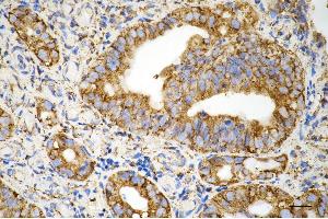 Immunohistochemistry was performed on paraffin-embedded human sigmoid colon carcinoma using prolyl 4-hydroxylase subunit beta antibody (ABIN7799920), 1:200).