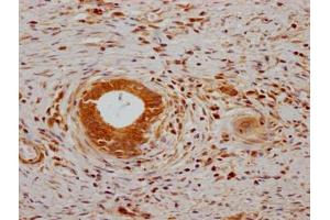 IHC image of ABIN7139767 diluted at 1:200 and staining in paraffin-embedded human gastric cancer performed on a Leica BondTM system. (CA9 Antikörper  (AA 38-414))